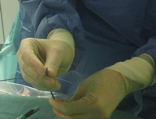 Radio frequency catheter ablation