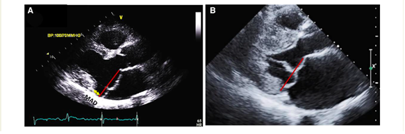 Figure 1- MVP with and without  MAD on TTE. TTE long-axis view in end-systole displaying bileaflet mitral valve prolapse with (A) MAD (yellow line) of 11 mm length vs. (B) without MAD. The red line indicates the plane of the mitral annulus (1) 
