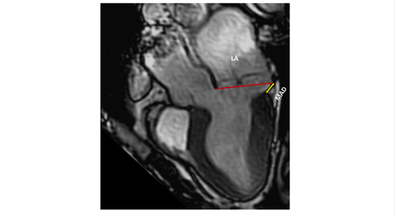Figure 2- MVP and MAD on CMR. CMR long-axis view in end-systole displaying MVP with MAD (yellow arrow). The red line indicates the plane of the mitral annulus (1). 