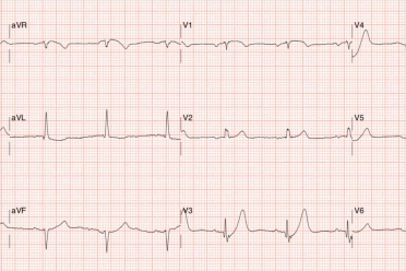 Acute-ECG-challenge-web.jpg