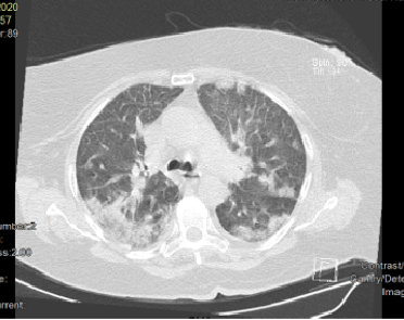 CT manifestations of COVID-2019: A retrospective analysis of 73 cases by disease severity – Eur J Radiology 2020