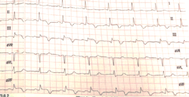 ECG(after7days).png