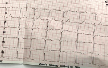 ECG2(after7days).png