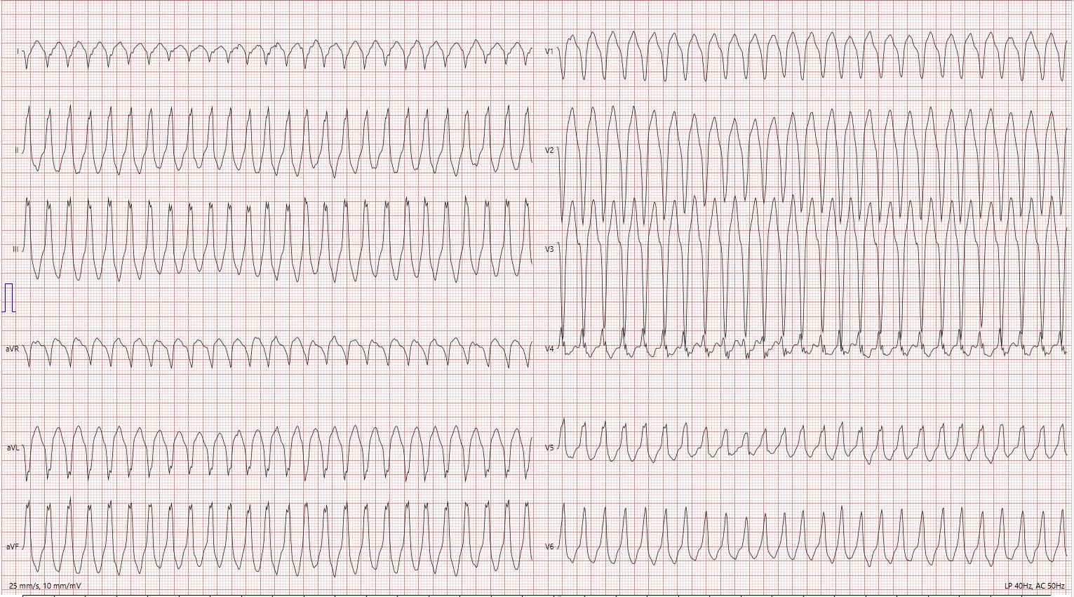 Exercise ECG.JPG