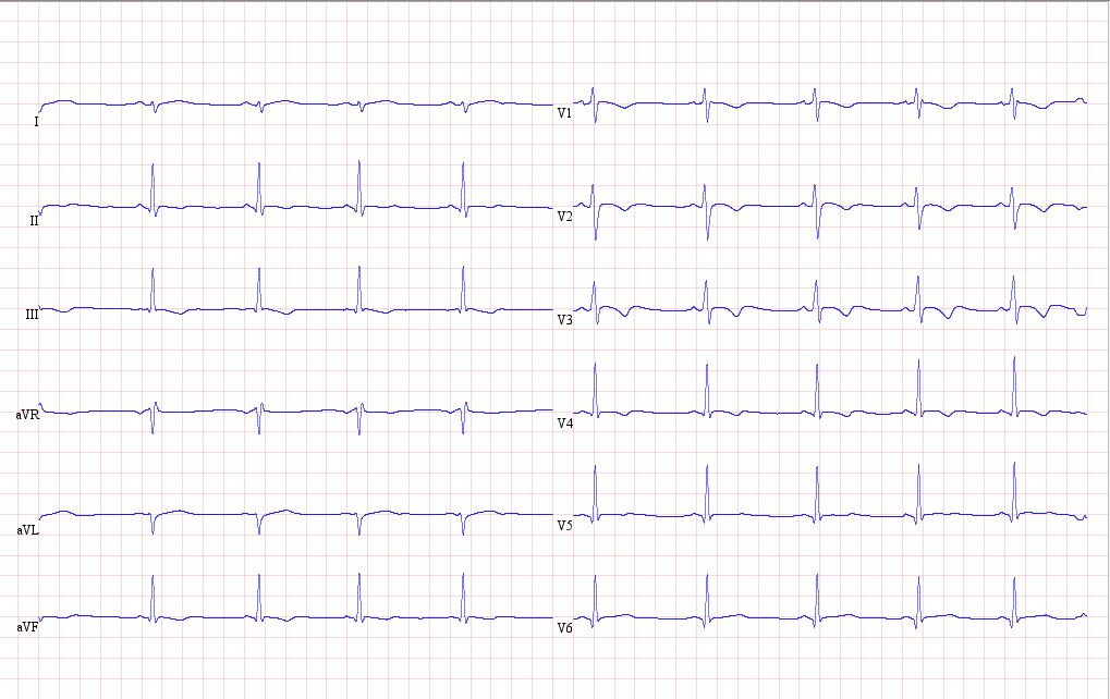 Resting ECG.JPG