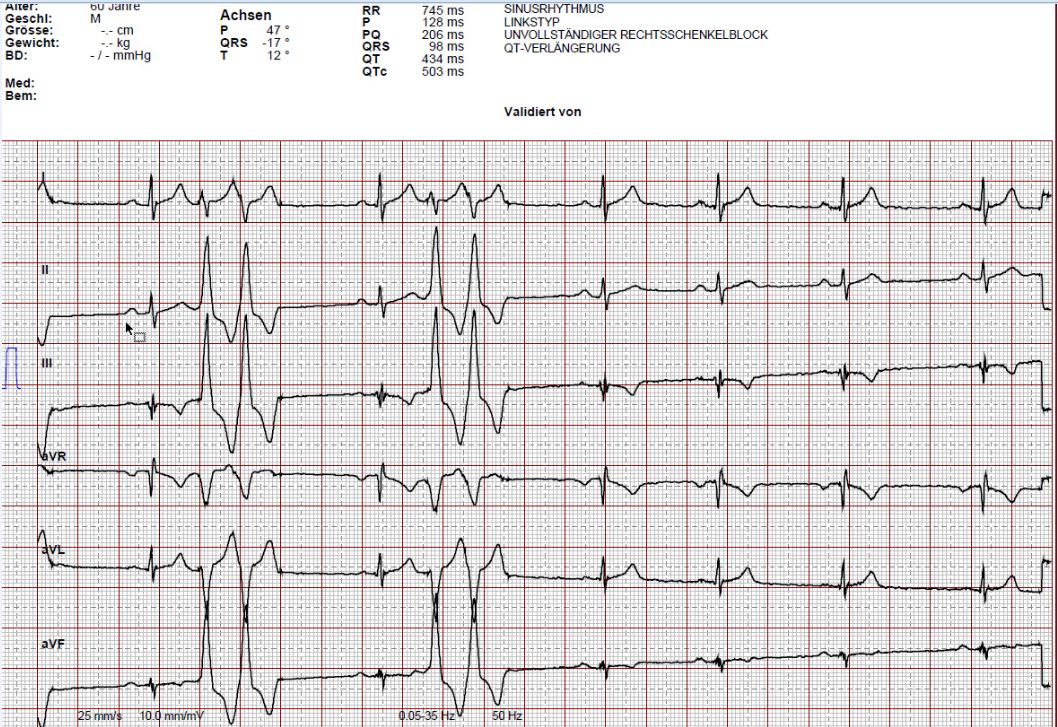 2019-05-case-ECG-12-limb-leads.JPG