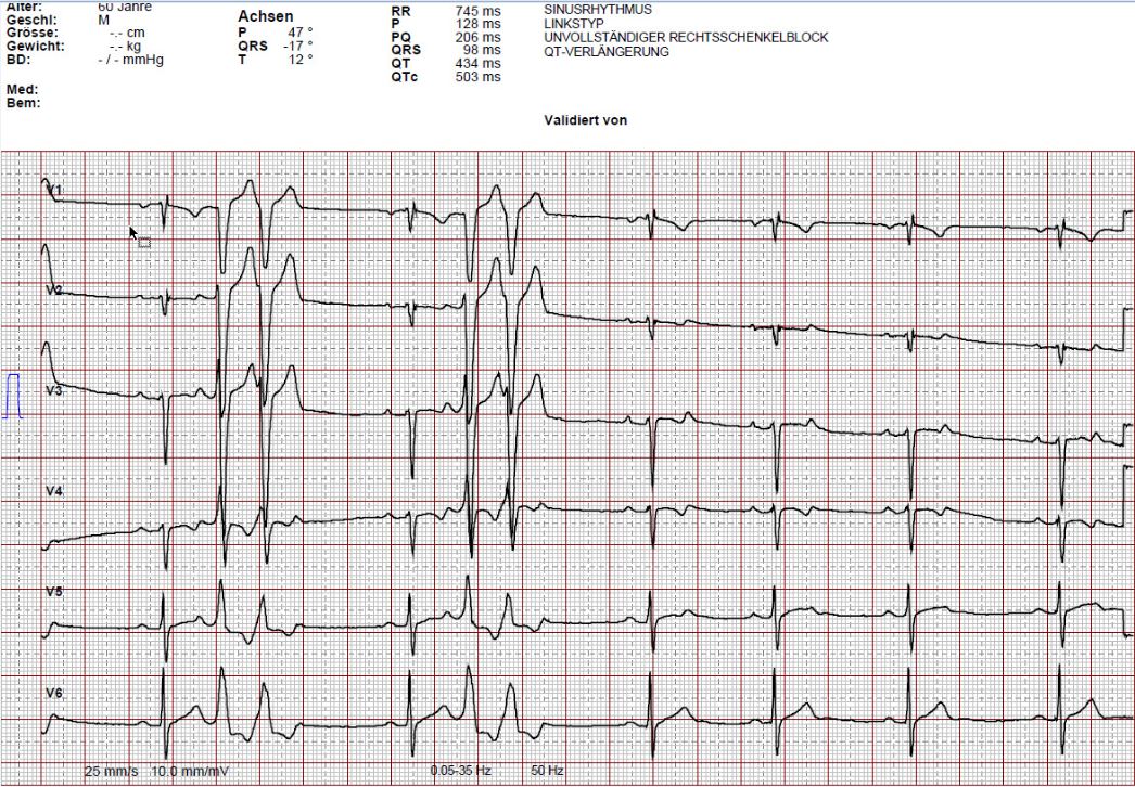 2019-05-case-ECG-precordial-leads.JPG