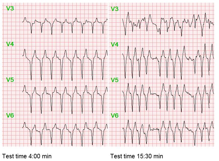 2019-06-CPX-Exercise-ECG.JPG
