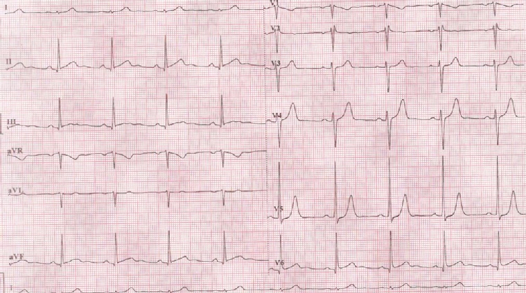 2019-10-ecg-quiz5.JPG