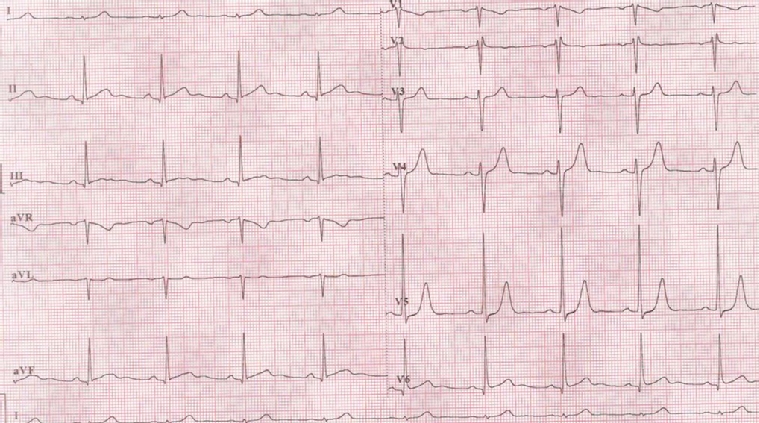 2019-10-ecg-quiz5.JPG