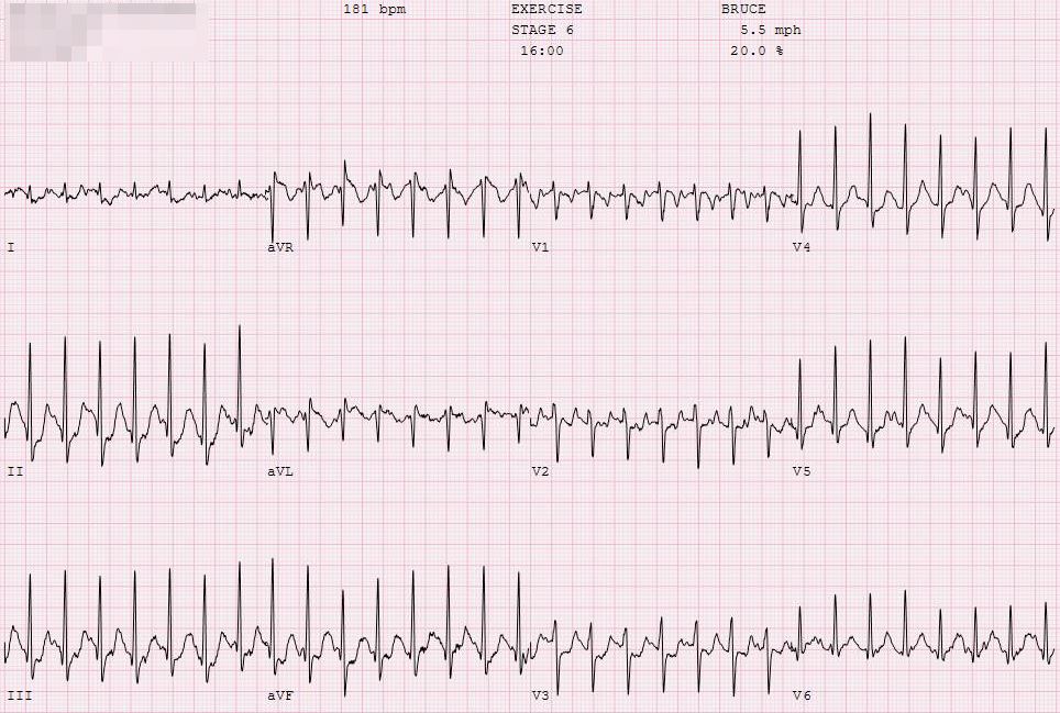 2020-sports-cardiology-case11-image2.JPG