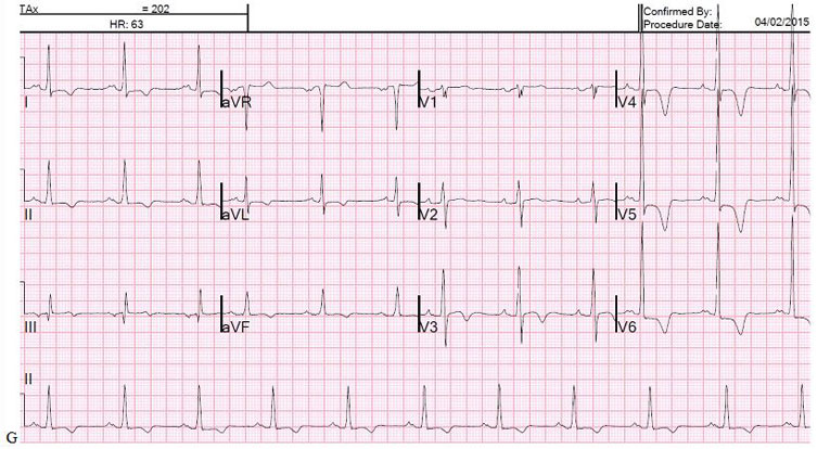 Case_Image_ECG apical-HCM_Jan2016_big.JPG