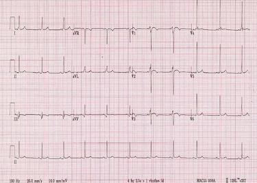 eapc-ecg-quiz-nov-2013-web_escardio-hPhotoMedium.jpg