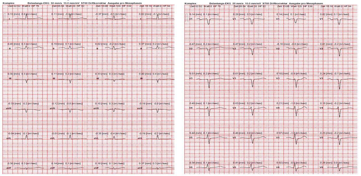 ECG extremities derivation (left) / ECG chest wall derivation (right)