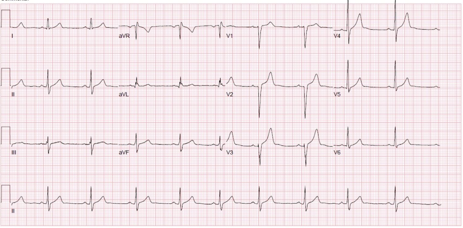 The athlete’s resting 12-Lead ECG – Figure A