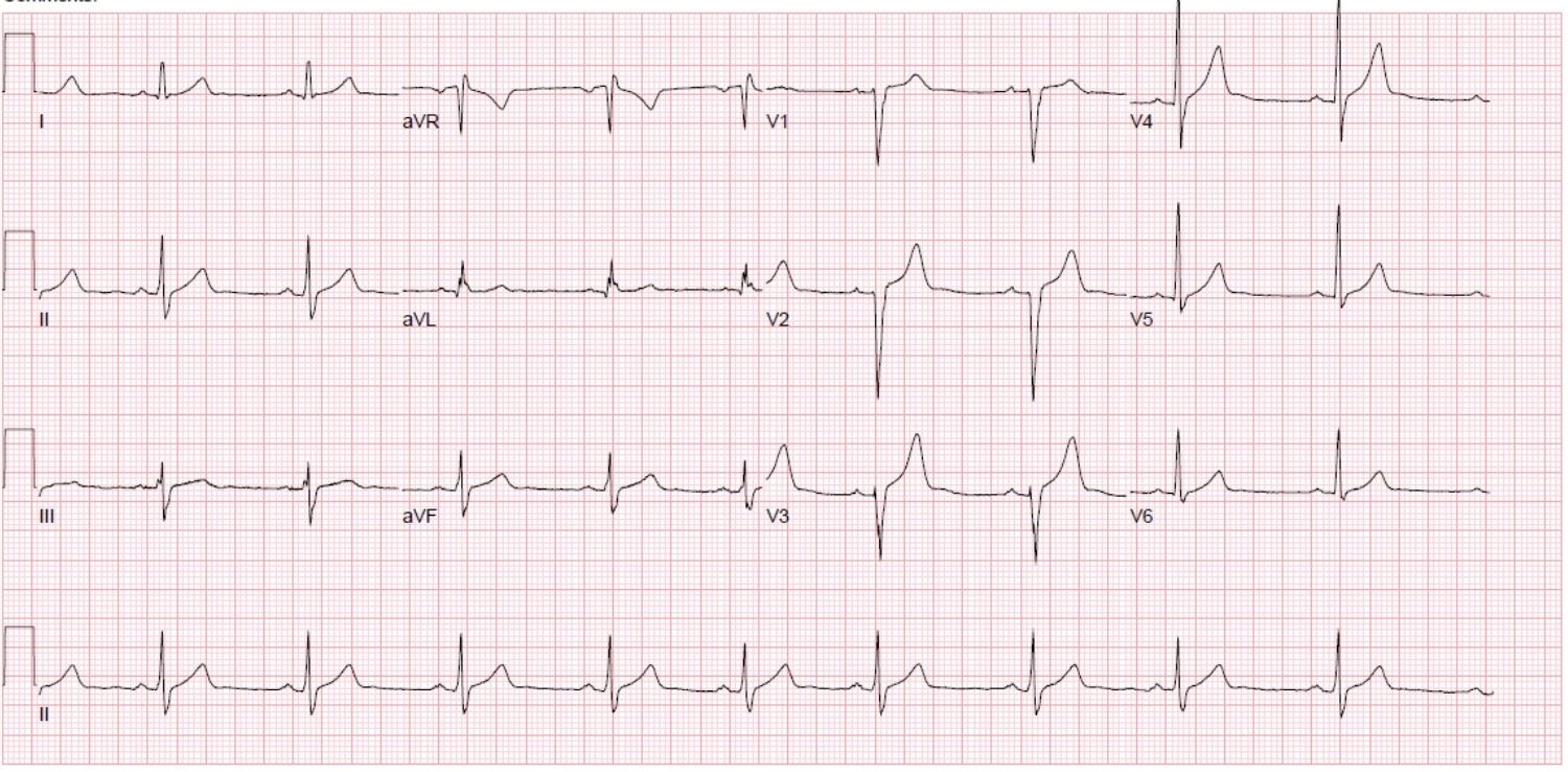 The athlete’s resting 12-Lead ECG – Figure A