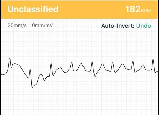 smartphone-based ECG recording - Figure B