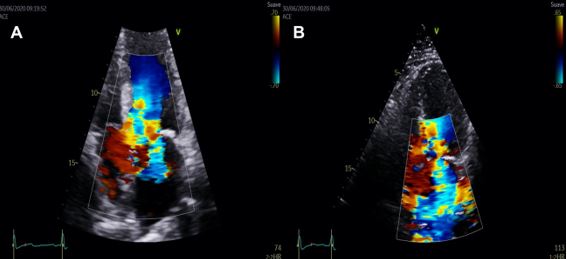 Measuring Left Ventricular Outflow Tract Signal Gradient in