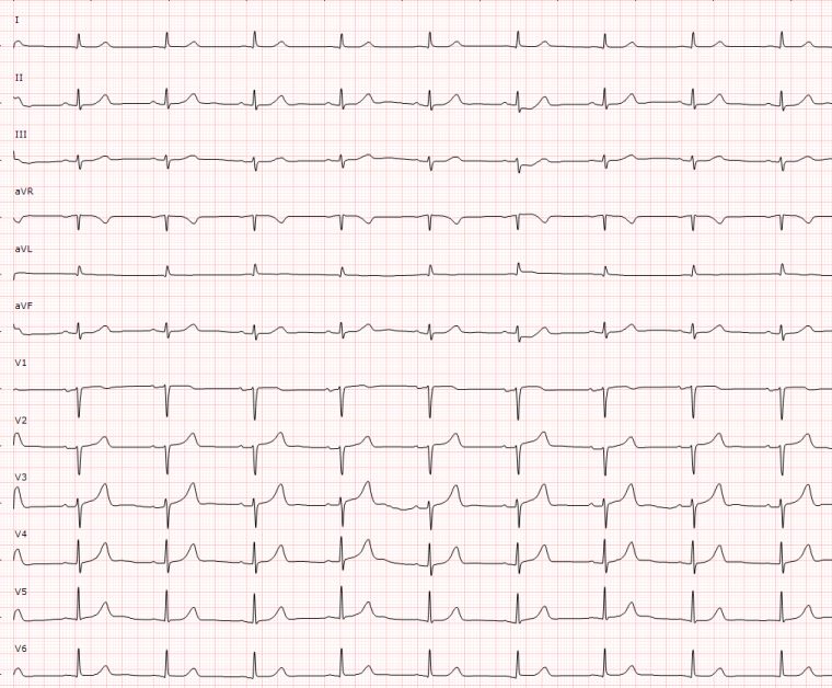 Baseline ECG showing sinus rhythm at 53 bpm, PR interval 175 ms and narrow QRS with low voltages in III, aVL and aVF leads.