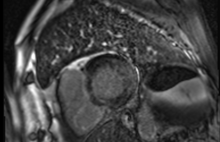 Cardiac magnetic resonance reported moderate LV hypertrophy (15mm) with multifocal late gadolinium enhancement mostly midwall and predominantly located in the lateral basal segment.