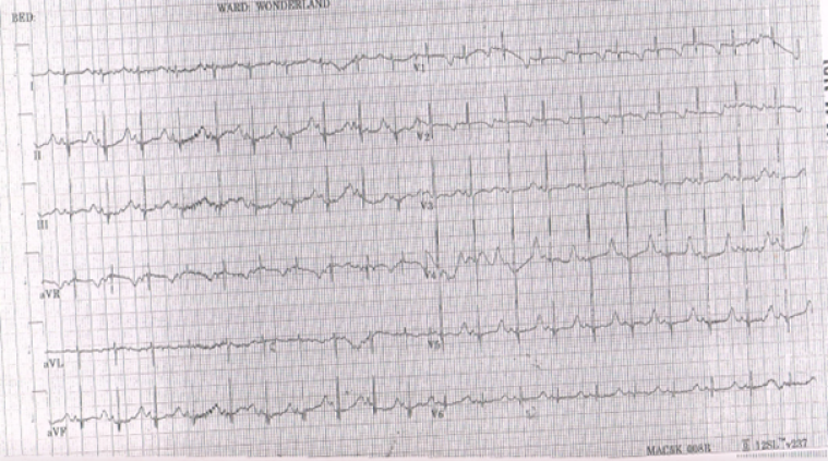 Image 2: Patient’s presenting ECG at 1 month of age, demonstrating a corrected QT interval of 500ms, with QRS complexes followed by a long isometric line ending with peaked and asymmetric T waves. 