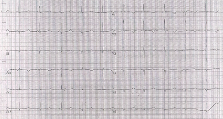 Image 2: Patient’s ECG at 1.5years of age, at follow up in cardiology clinic, subsequent to the second symptomatic event. This demonstrates a QTc of 600ms. 