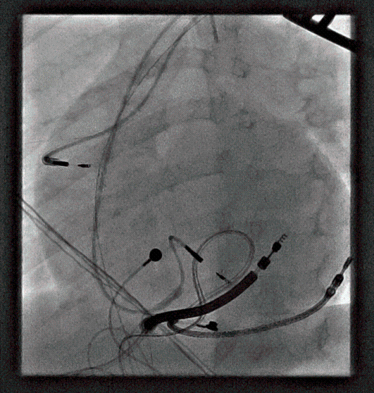 Image 3: Still view from cardiac catheterisation post ICD revision procedure, showing the lead and coil positions.
