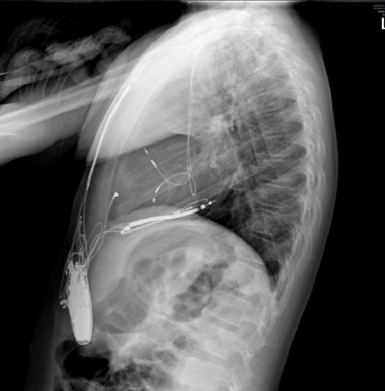 Image 4: Antero-posterior (a) and lateral (b) chest X-Ray of the patient post ICD revision showing the lead and coil positions.  