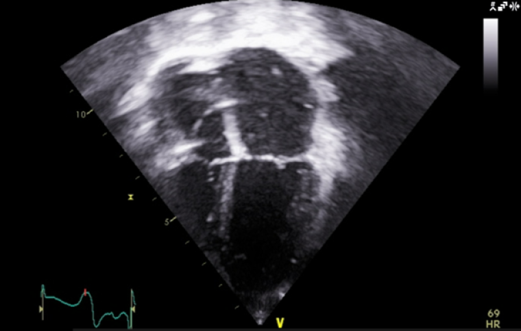 Image 5: 4 chamber view of echocardiogram demonstrating a dilated left and right atrium and the ICD lead in the right atrium 