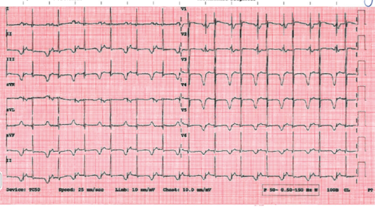 Image 6: Patient’s most recent ECG, aged 11, showing atrial pacing and ventricular sensing at 80 beats per minute. His QTc is 581ms with negative T-waves across the inferior and precordial leads, each preceded by a long isoelectric segment. 