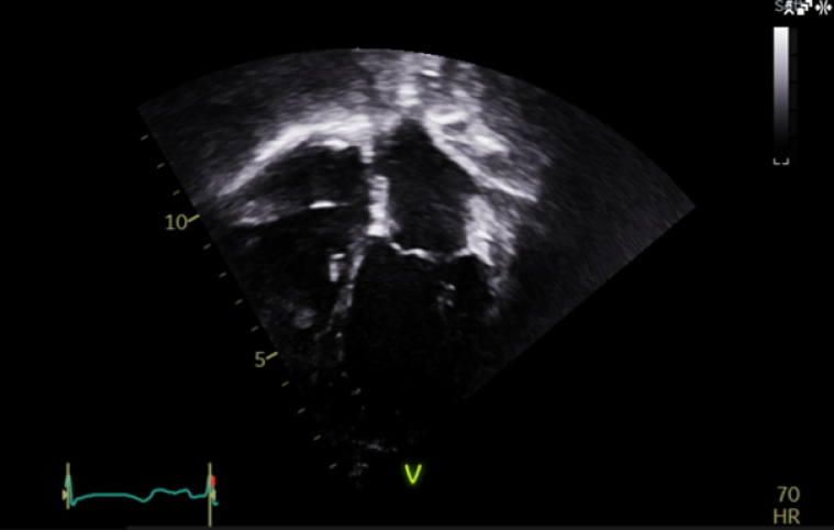 Image 7: Most recent echocardiogram, 4 chamber view, showing stable appearances 