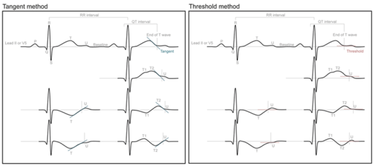 Figure 1 Illustrating the 2 different methods to measure the end of the T wave and how to deal with biphasic T waves (T1-T2) and U waves (from4)