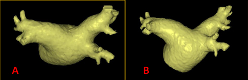 Example of LA segmentation from a CT scan. 