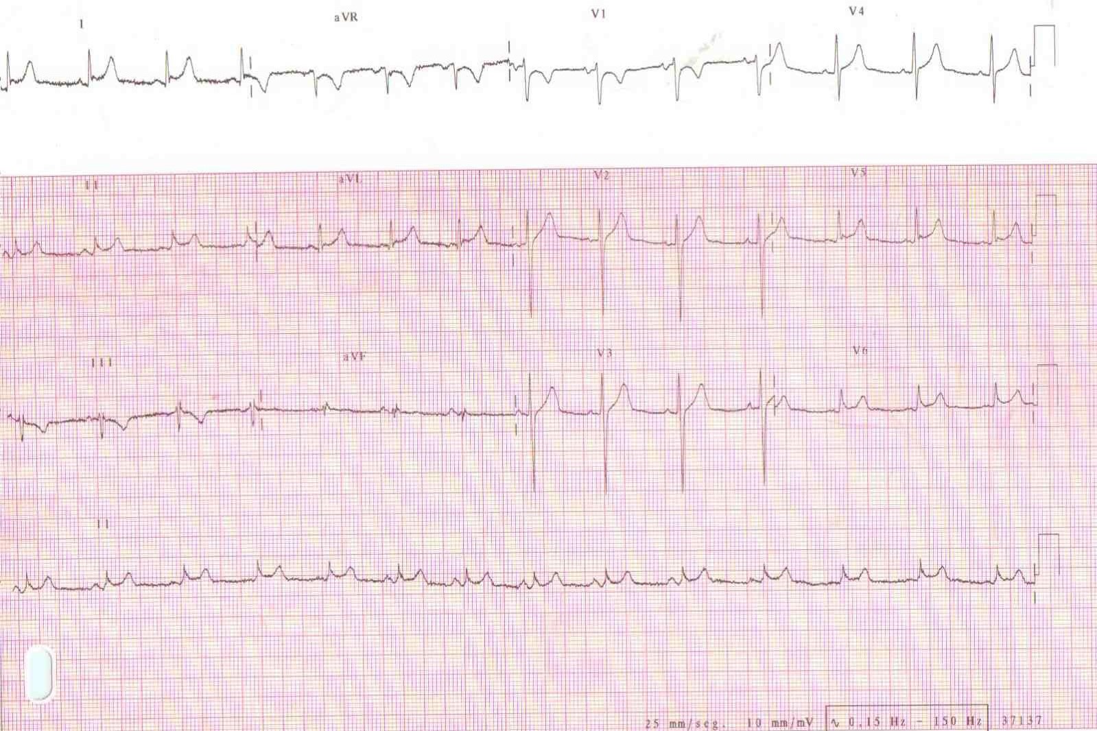 Diagnosis Of Acute Pericarditis