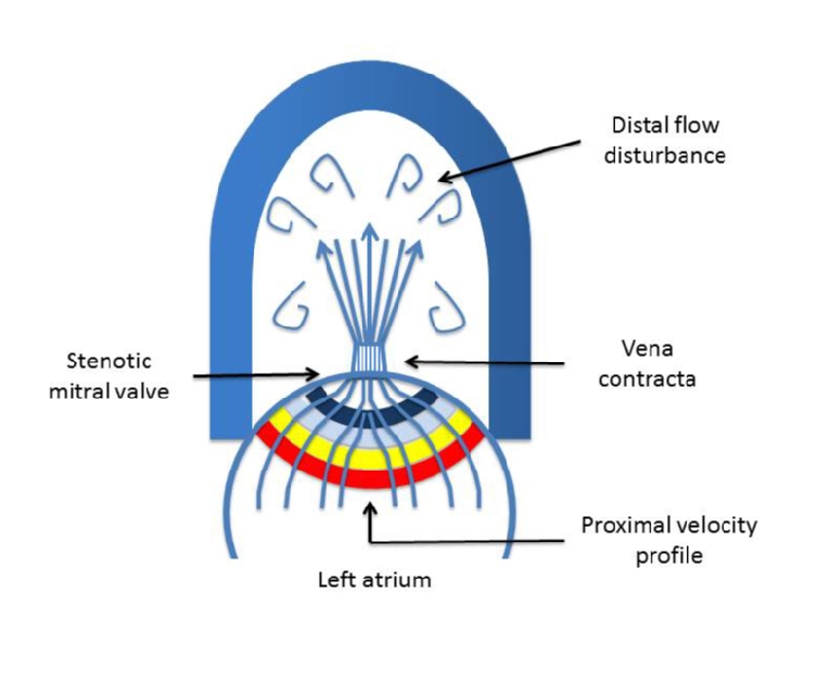 Mitral Valve Disease Correlation Between The Most Important Echocardiographic Parameters And Haemodynamics