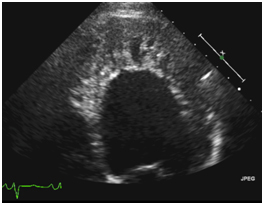 Acute on Chronic Heart Failure Secondary to Left Ventricular Noncompaction