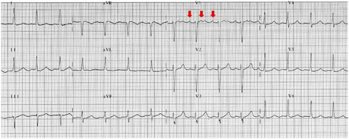 Atrial Flutter Common And Main Atypical Forms