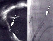 Figure 1. Intra cardiac echocardiogram (ICE) of the right atrium (transversal plane) with the oval fossa and the transseptal needle (arrow). At the right the (frontal) corresponding X-ray is shown, with echo catheter and transseptal sheath with needle.