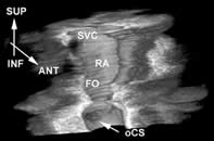 Figure 2. Three dimensional reconstruction of the right atrium (lateral view) with superior vena cava (SVC), oval fossa (FO) and ostium of the coronary sinus (oCS).