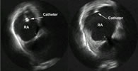 Figure 4. Transversal view in the right atrium (RA) showing how the catheter is not well appositioned to the wall at the left and makes contact at the right (ICE).