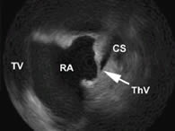 Figure 3. ICE picture showing a thebesian valve (ThV), obstructing the coronary sinus (CS). RA: right atrium, TV: tricuspid valve.