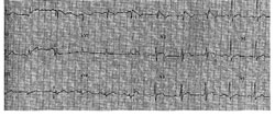 34 years old male, asymptomatic, no family history, routine ECG. Echocardio normal, Holter normal, stress test normal. EPS advised, refused by the patient. Eight months later: sudden arrhythmic death at 1 a.m., VF when EMS arrives. Necropsy: normal heart, normal coronary arteries. No other cause for sudden death: probably arrhythmic