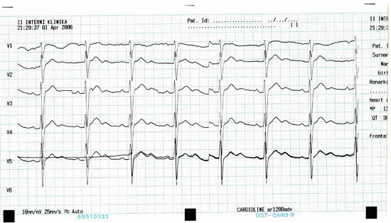 Fig. 1: ECG of a Patient with Hypokalemia 2,7 mmol/l