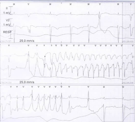 Fig. 2: Iatrogenic torsades de pointes in a patient with long Q-T (0,54 s) due to hypokalemia caused by excessive diuretic therapy.