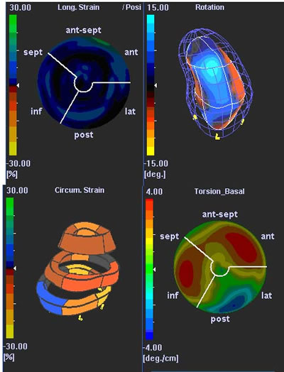 Figure 1: Different parameters (longitudinal strain, rotation, circumferential strain and torsion-basal) displayed in different 