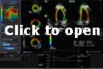 Figure 2: Final representation of a normal heart, after automatic software detection of endocardium and epicardium. 