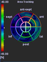 Figure 3: This polar map shows the area tracking analysis in a patient with a severely depressed left ventricular EF