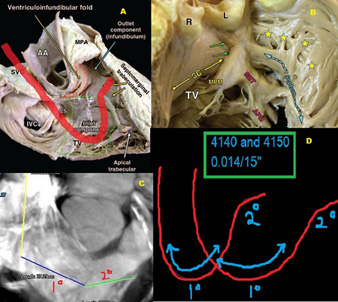 Echo image of right ventricular apex (RVA) pacemaker, pressure