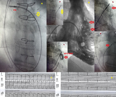 Echo image of right ventricular apex (RVA) pacemaker, pressure