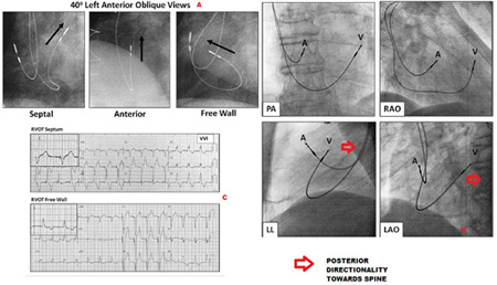 Echo image of right ventricular apex (RVA) pacemaker, pressure